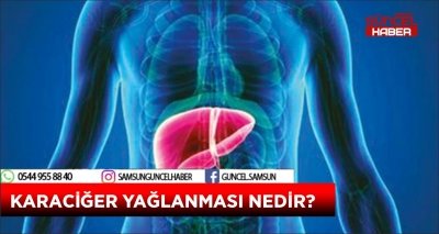 KARACİĞER YAĞLANMASI NEDİR?